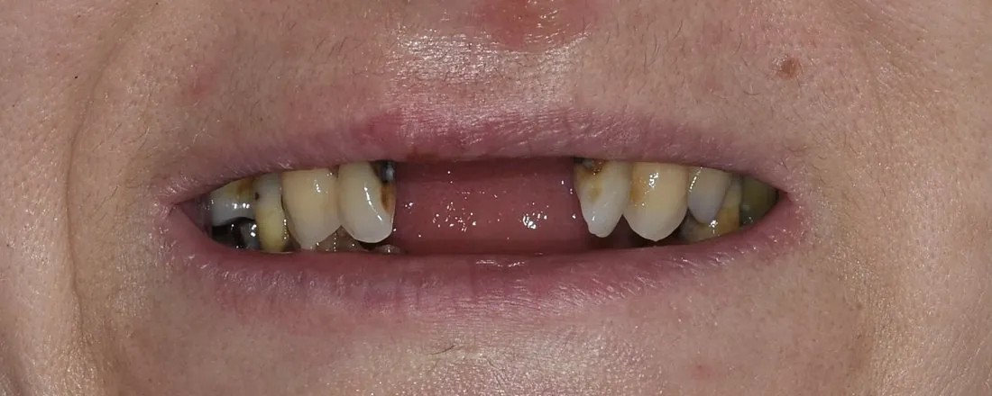 Antes do tratamento — reabilitação estética do sorriso, CMDC Celeirós