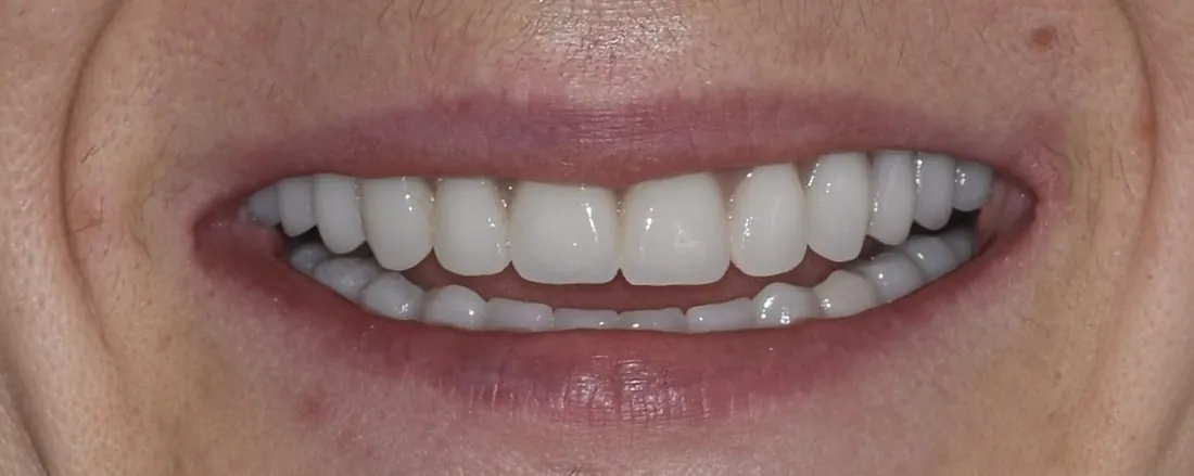 Depois do tratamento — reabilitação estética do sorriso, CMDC Celeirós
